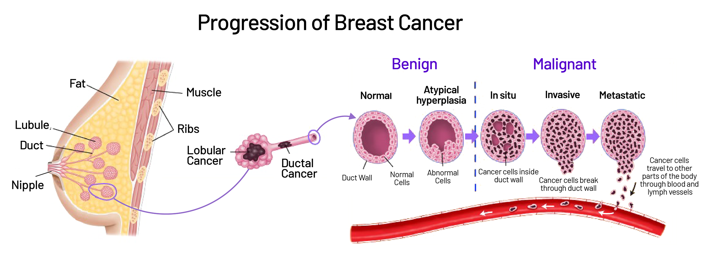 breast cancer symptoms and causes