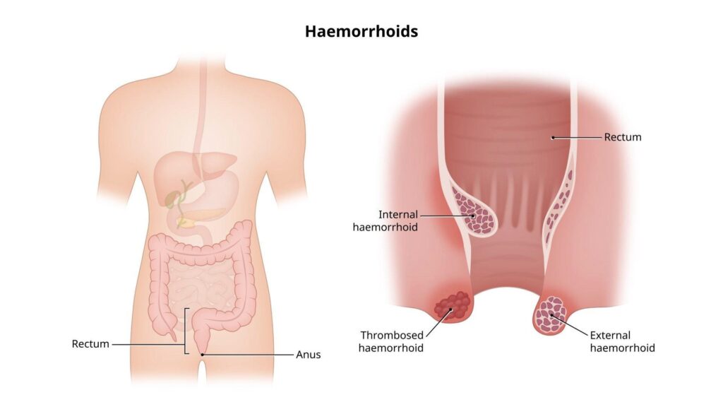 Piles (Hemorrhoids)