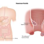 Piles (Hemorrhoids)