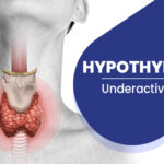 Hypothyroidism Symptoms and Causes