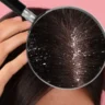 Itchy Scalp