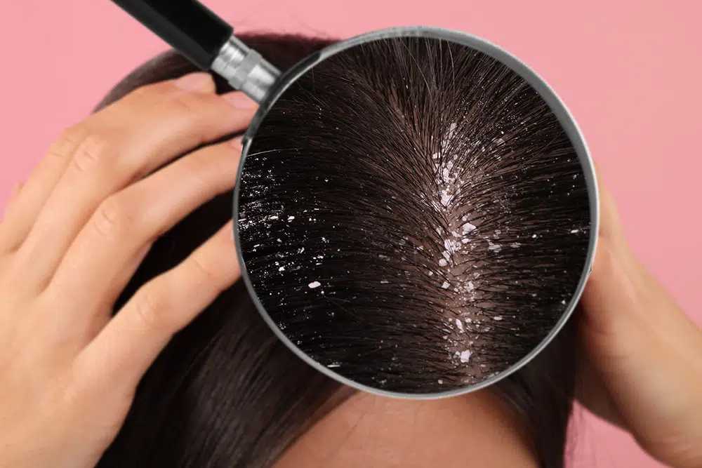 Itchy Scalp