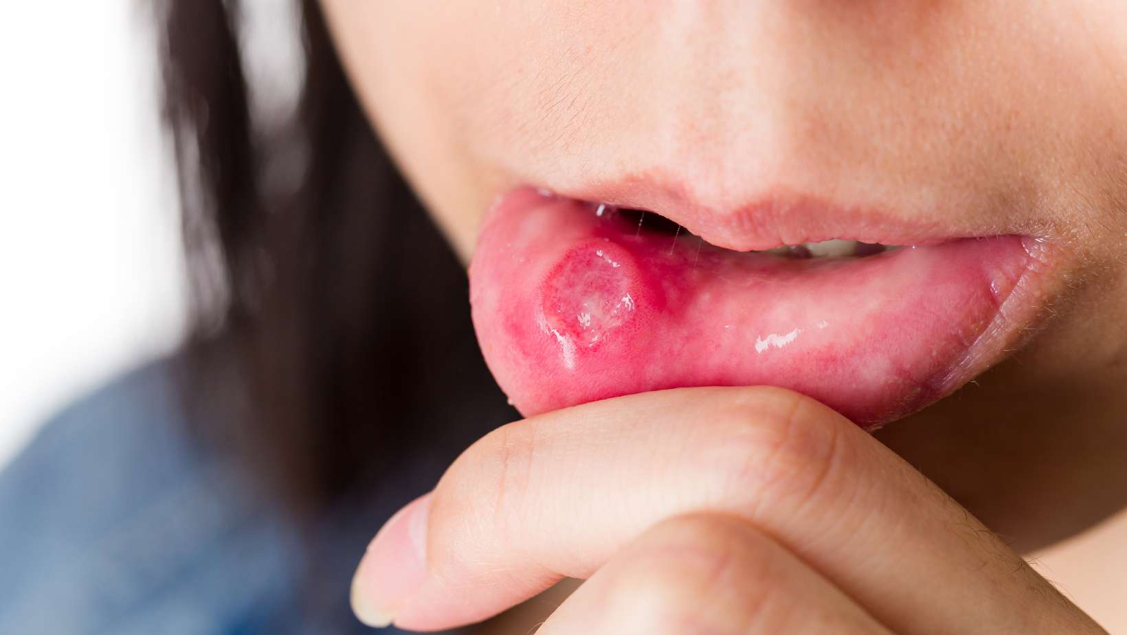 mouth ulcer causes and treatment
