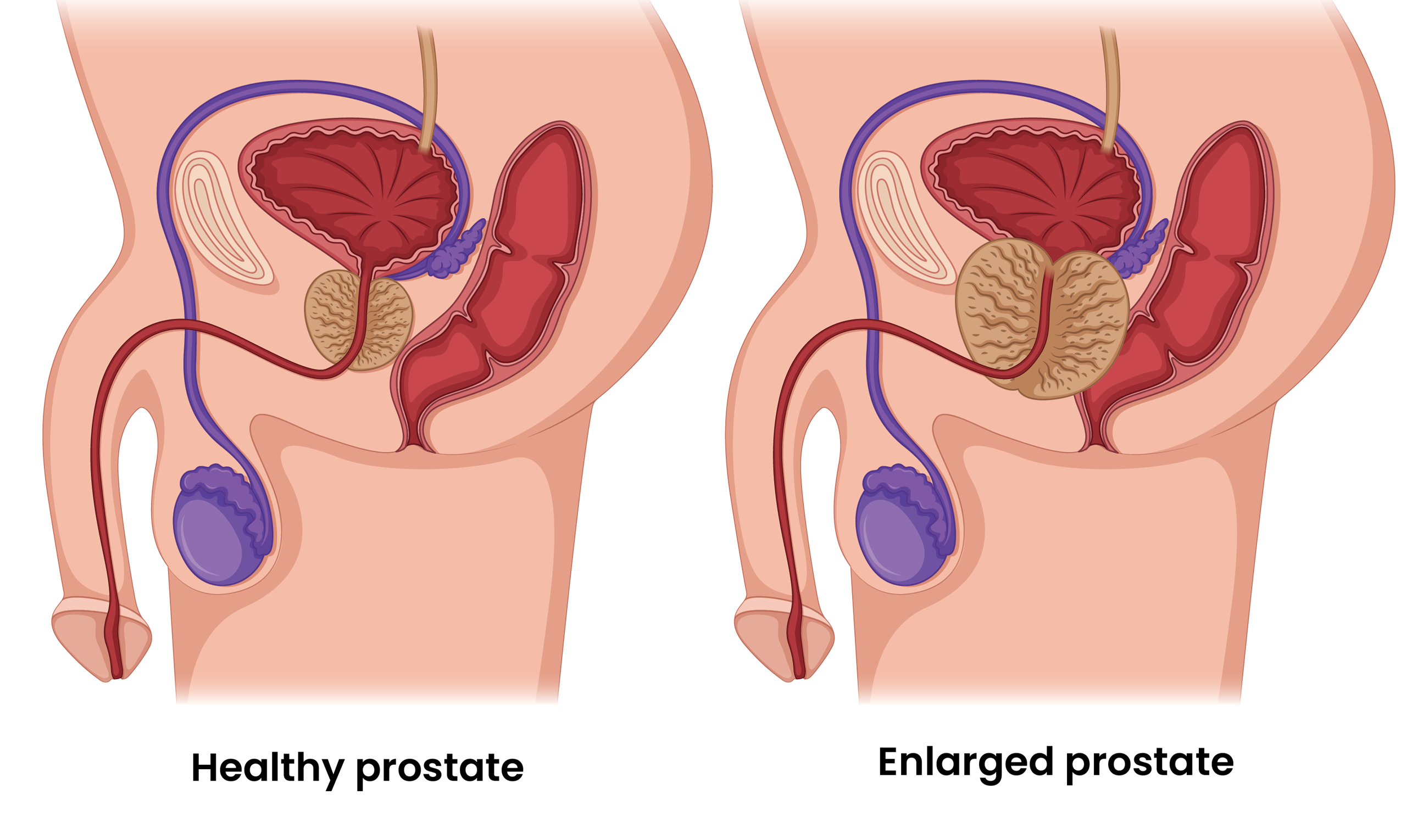Shrink Prostate