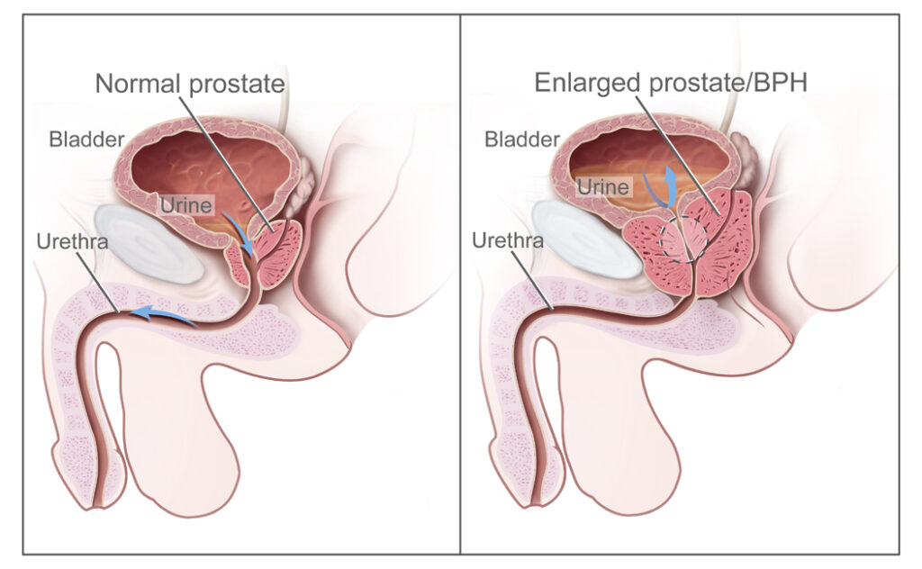 Shrink Prostate