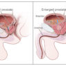 Shrink Prostate