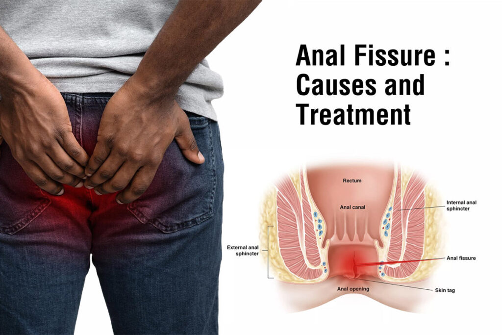 Anal Fissures