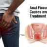 Anal Fissures