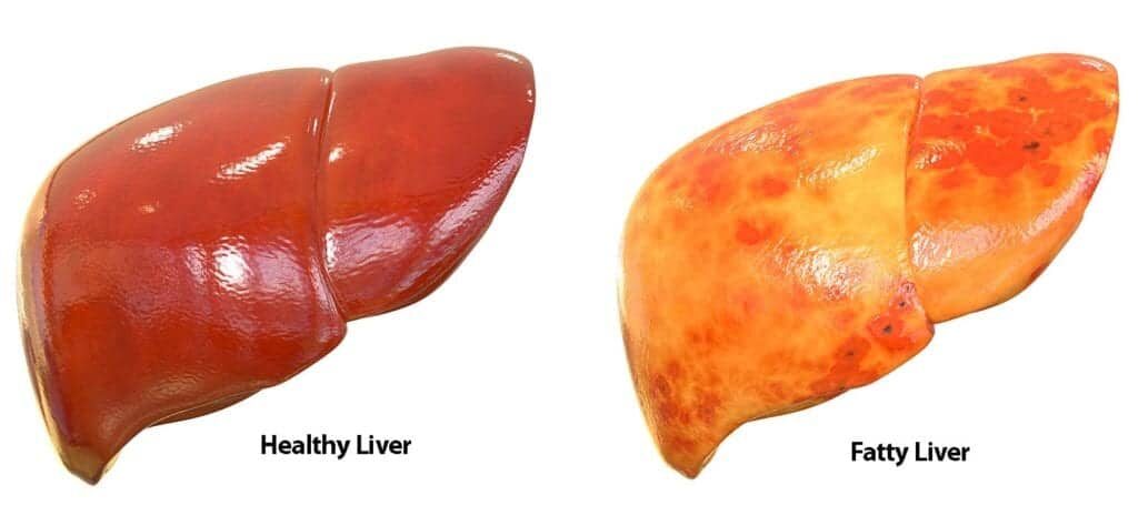 fatty liver