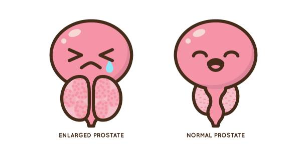 How to Naturally Shrink the Prostate