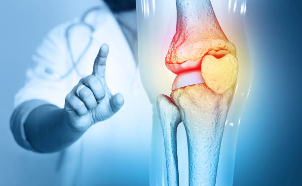 How to Stop Osteoarthritis: Home Remedies and Exercises for Knee Health