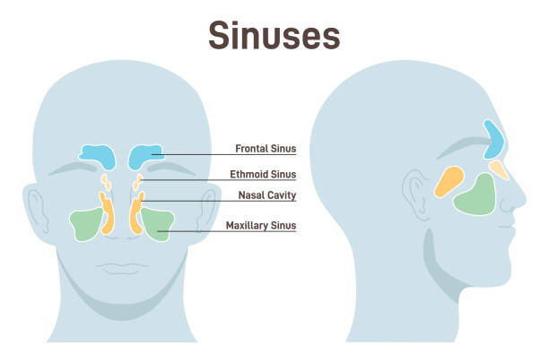 Sinus (Sinusitis): Causes, Symptoms & Treatment, Home Remedies