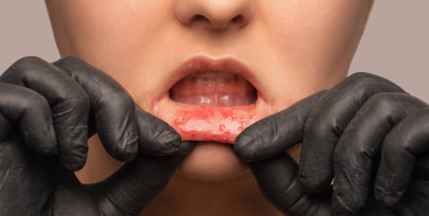 Oral Ulceration: Causes, Management, and Product Recommendations