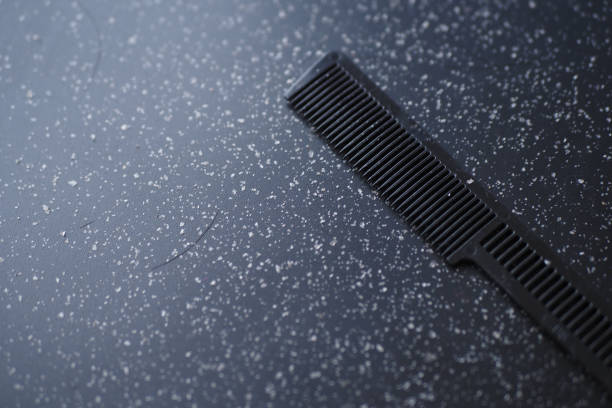 15 Natural Remedies to Cure Dandruff Effectively