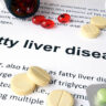 Fatty Liver: Causes, Symptoms, and Treatment, Home Remedies