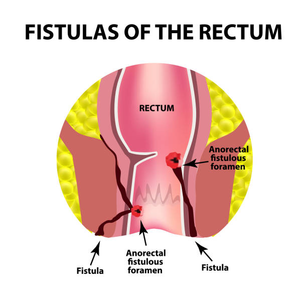 LASER Surgery for Anal Fissures and Fistulas: A Comprehensive Guide