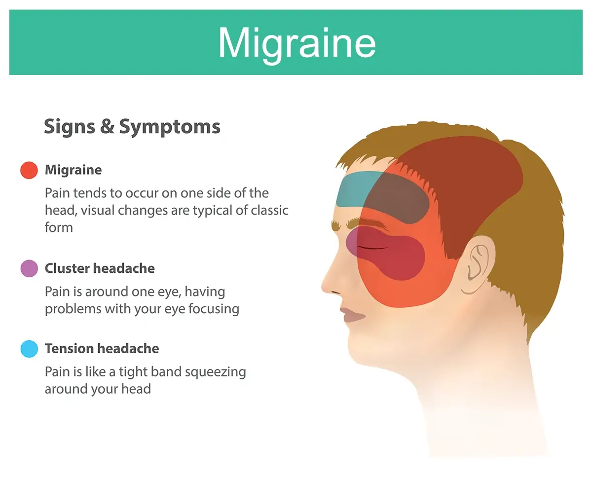 migraine relief