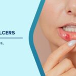 mouth ulcer causes and treatment