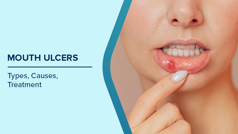mouth ulcer causes and treatment