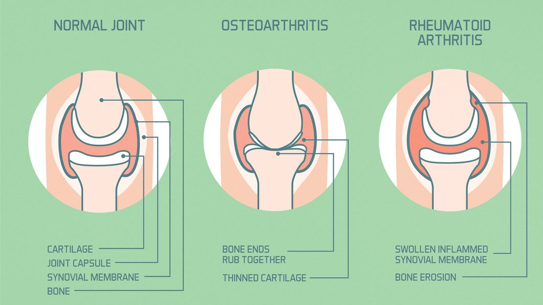 osteoarthritis home remedies