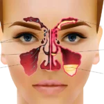 sinusitis