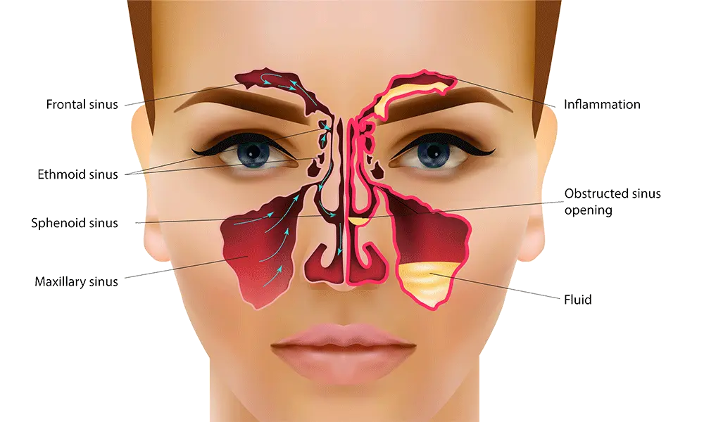 sinusitis