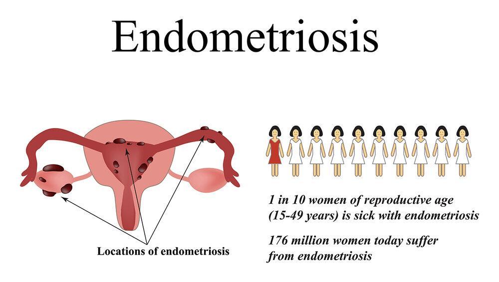 endometriosis symptoms and treatment